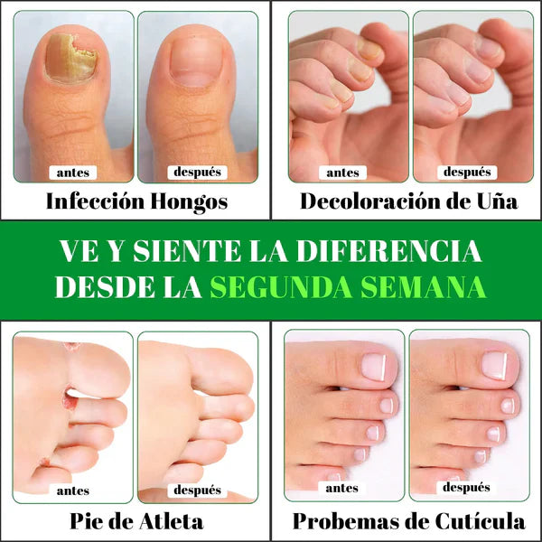 GOTAS DE TERBINAFINA QUITA HONGOS - S007