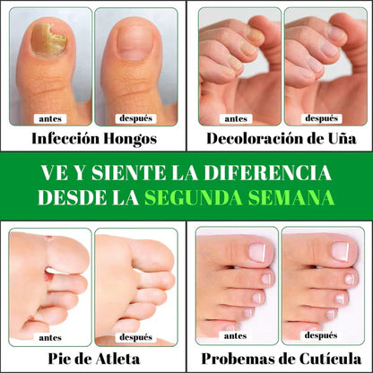 GOTAS DE TERBINAFINA QUITA HONGOS - S007